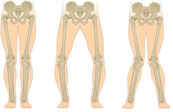 Aarte vu Arthrosis
