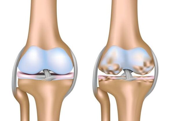 Arthrosis
