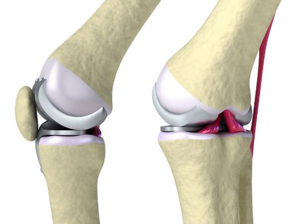 Prosthetik vum Knie Gelenk