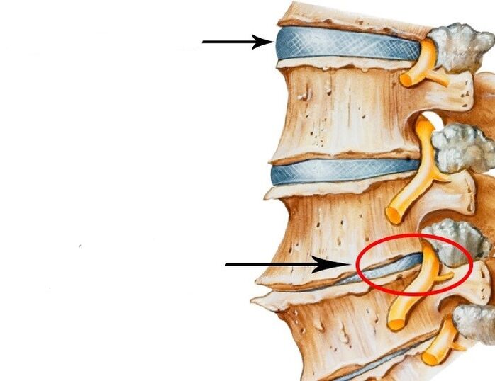 Beschiedegt Scheif a verletzt Nerve mat Gebärmutteral Osteochondrosis