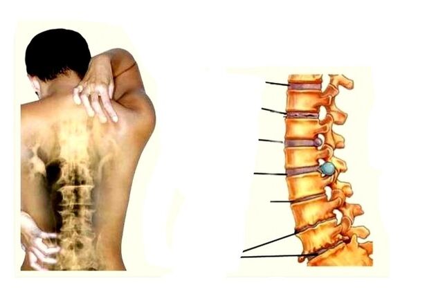 Zänn vun der Entwécklung vun Osteochondrosis
