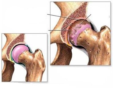 Arthrosis vun der Hip Gelenk