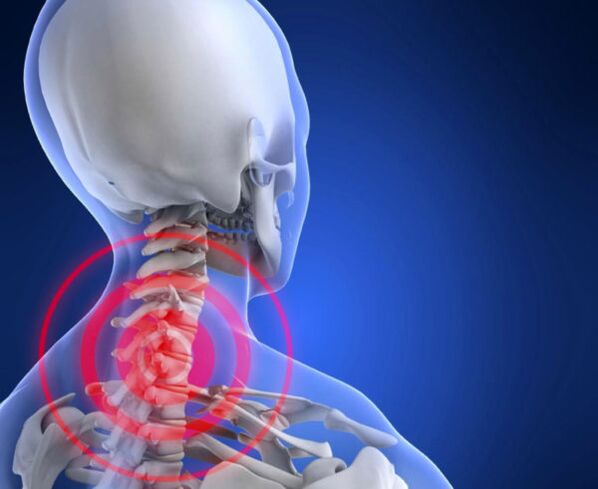 Osteochondrose vun der cervical Wirbelsäule