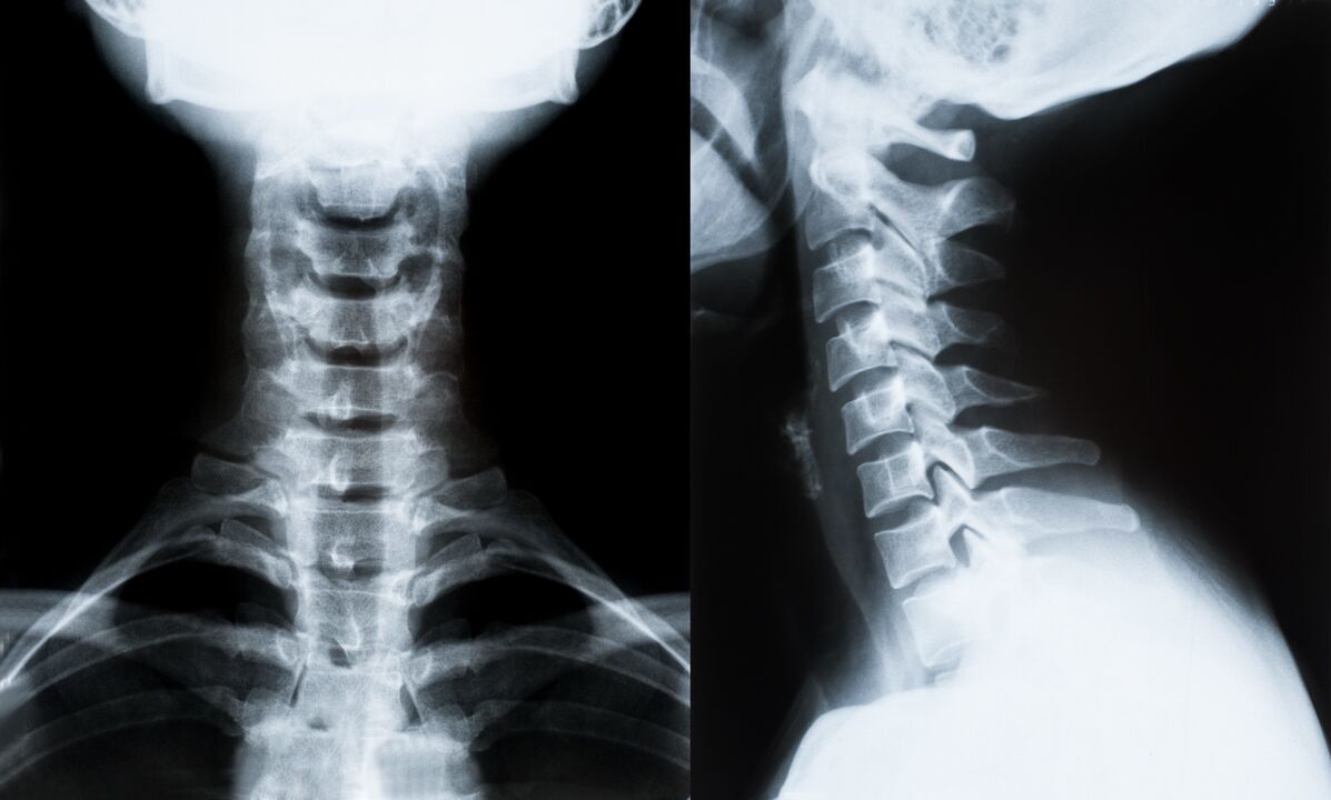 cervical osteochondrosis op x-Ray