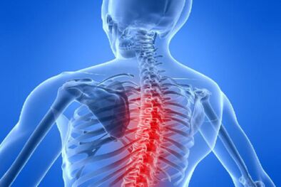 Spinalkordkompressioun an der thoracescher Osteochondrose